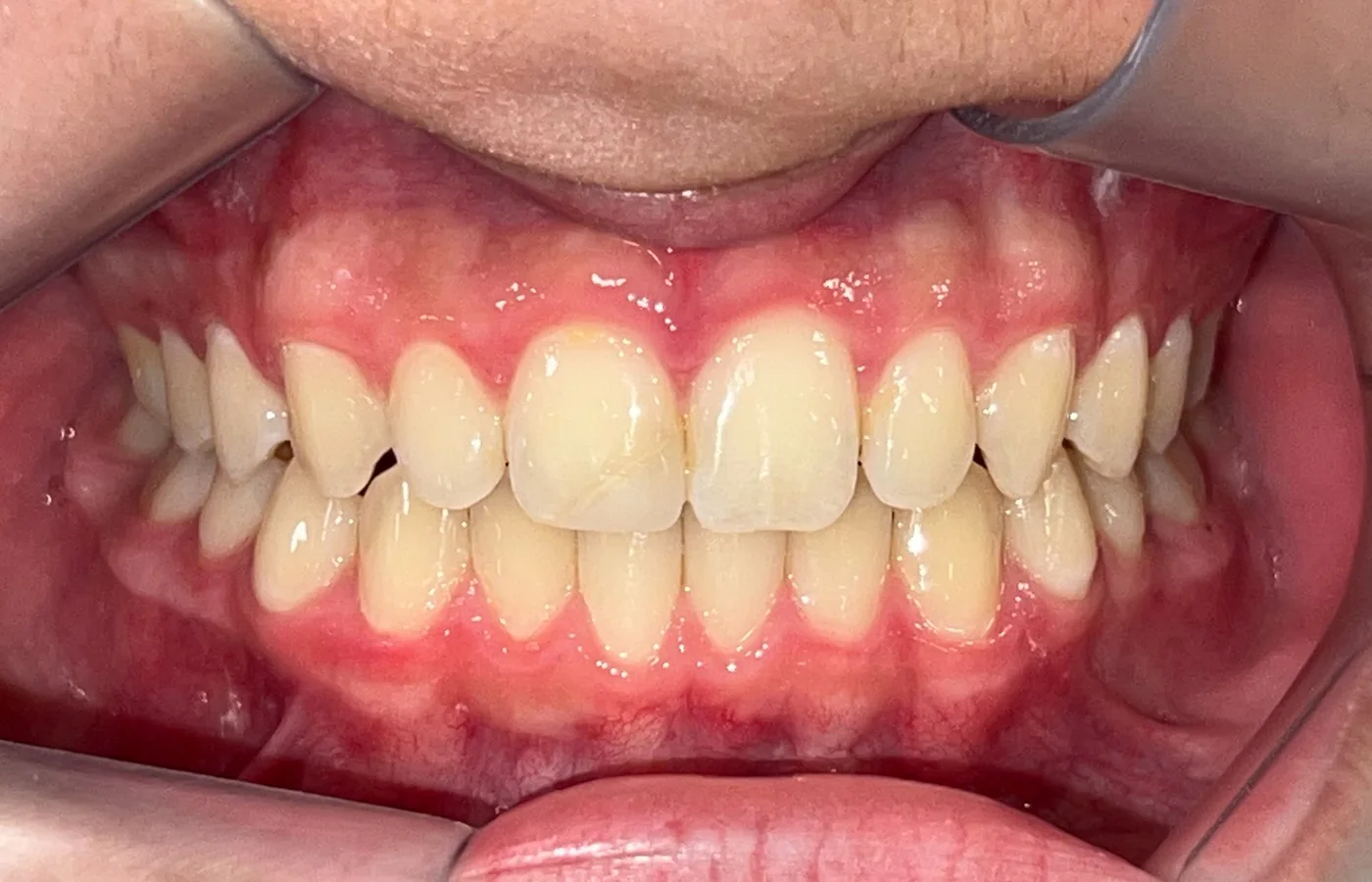 Vista frontal após o tratamento odontológico do caso apresentado